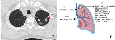 Immunohistochemistry combined with NGS to assist the differential diagnosis of multiple primary lung cancer with lymph node metastasis: a case report